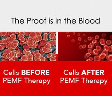 Before and after PEMF Therapy